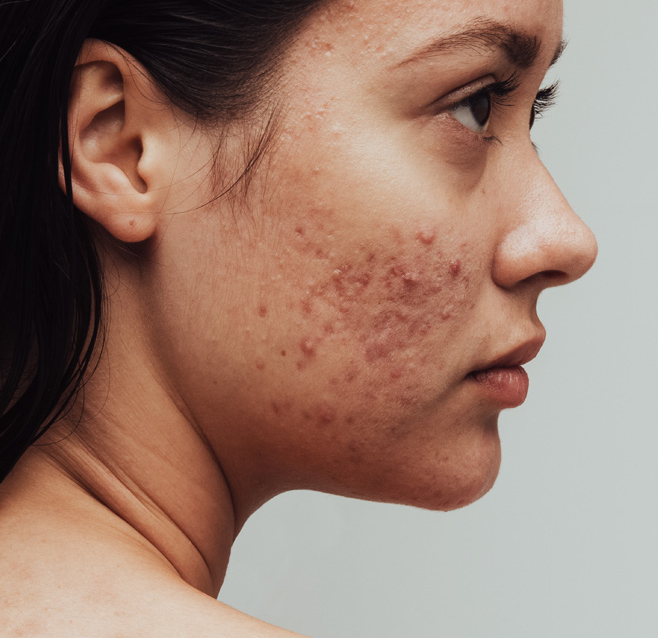 ACNE TREATMENT LIVERPOOL ACNE CAUSES SYMPTOMS & TREATMENTS