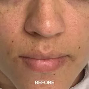 enlarged pores treatment near me