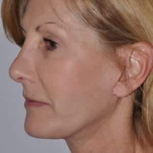 Non-Surgical Facelift Liverpool after