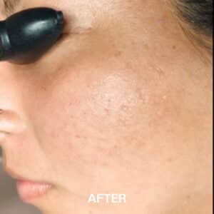 acne treatment for adults
