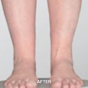 Cankle Surgery Liverpool