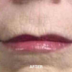 lips line removal