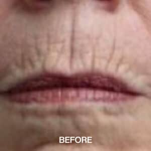 lips line removal liverpool