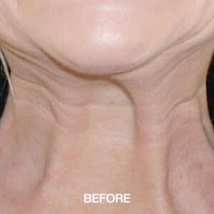 Nefertiti Neck Lift Liverpool