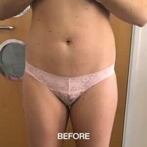 Before BODY HIFU Liposuction Liverpool Image