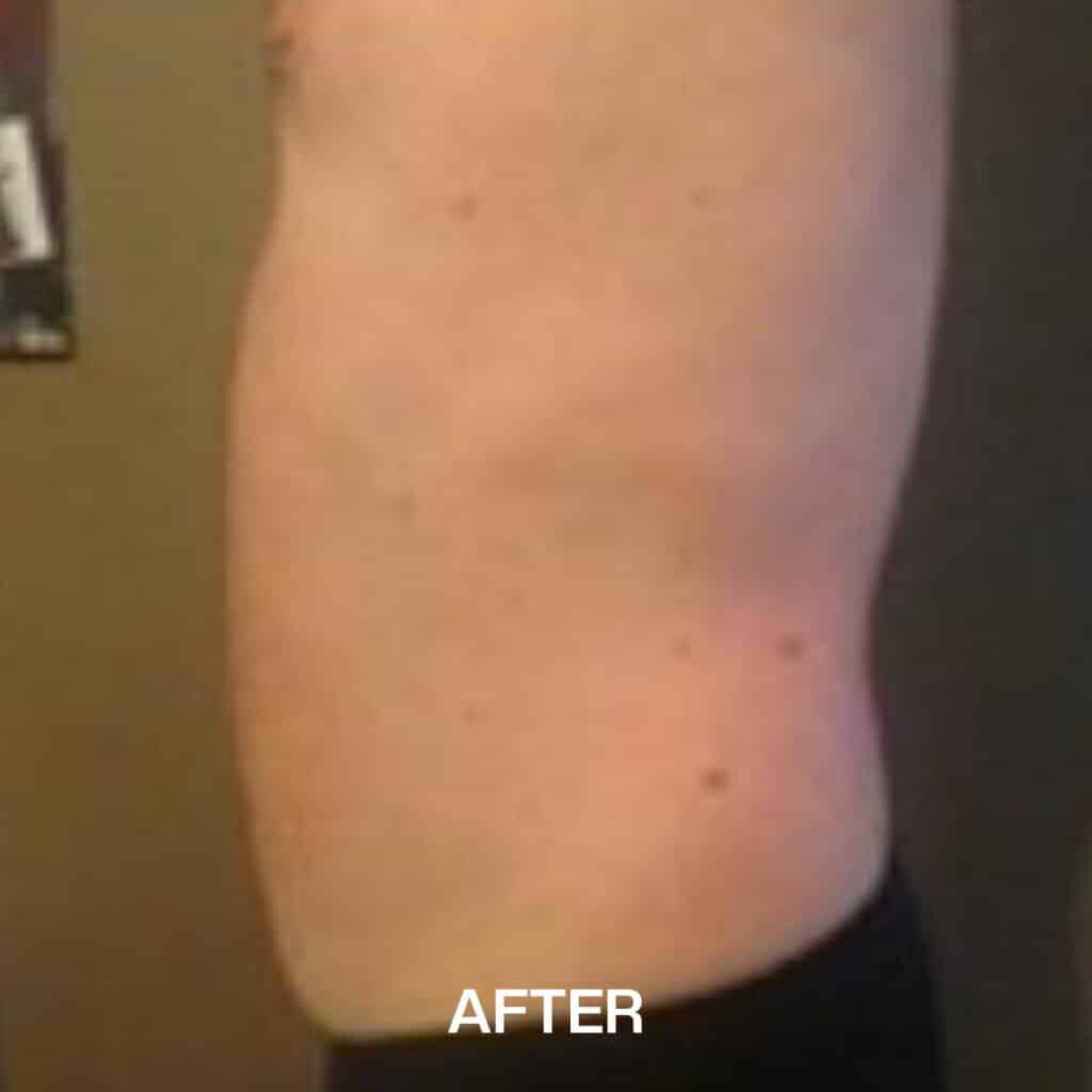 cavitation-after