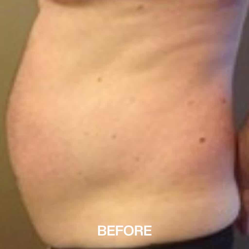 cavitation-before