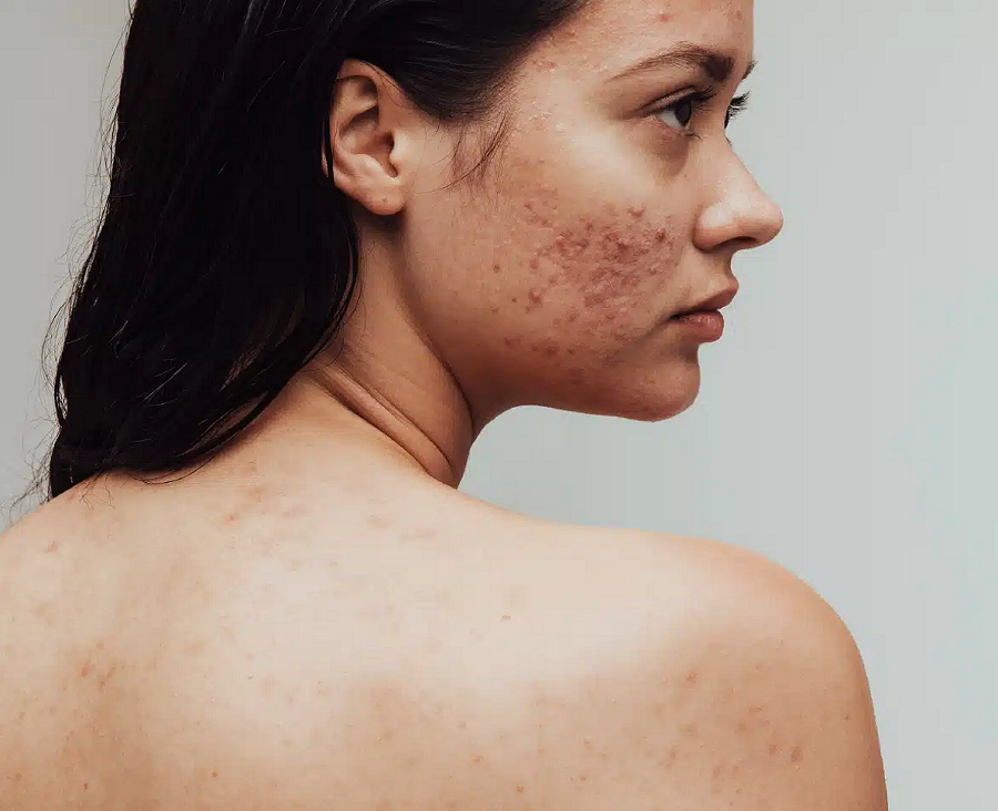 Acne Scarring