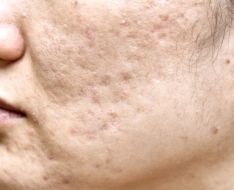 Acne Scarring