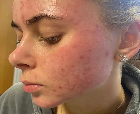 Acne Treatments
