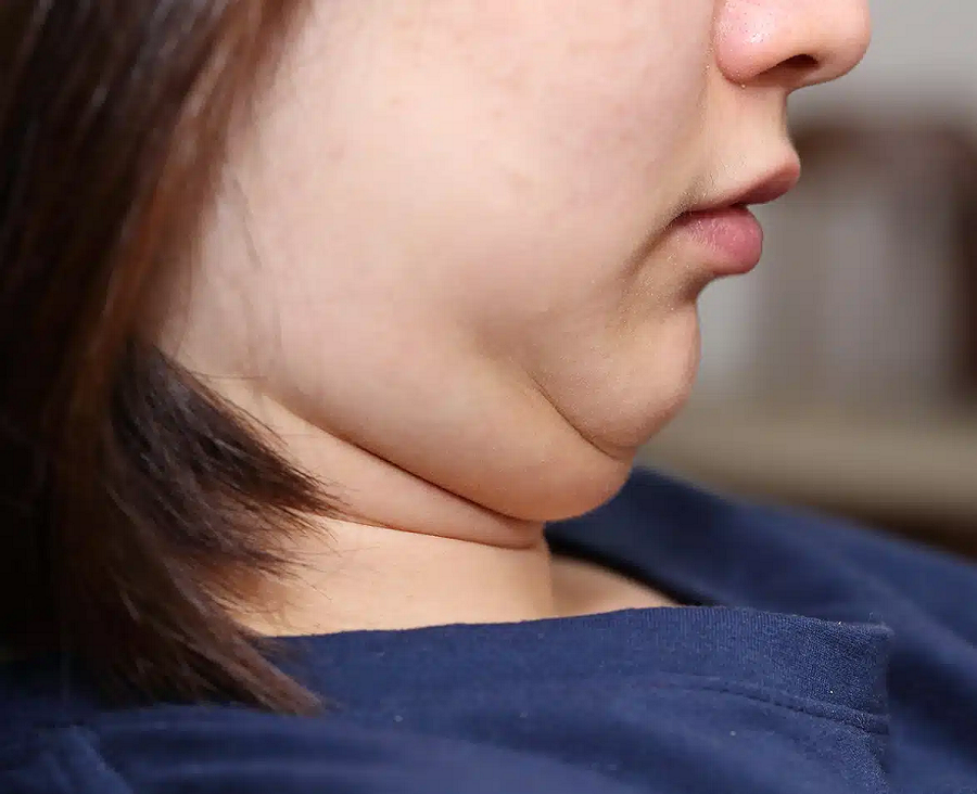 Double Chin