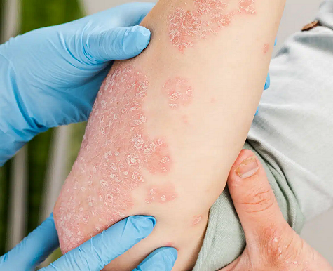 HBOT PSORIASIS LIVERPOOL