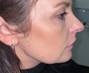 TIGHTEN SAGGING JOWLS LIVERPOOL