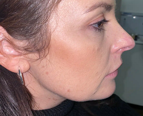 TIGHTEN SAGGING JOWLS LIVERPOOL