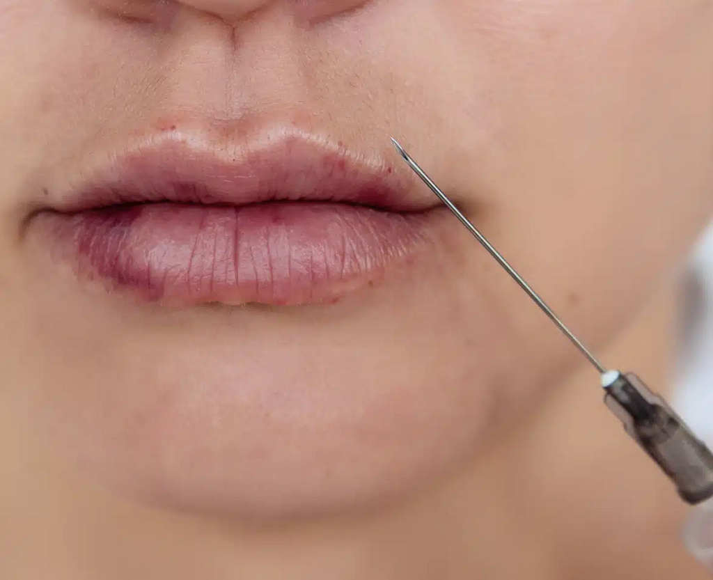 DERMAL LIP FILLER LIVERPOOL