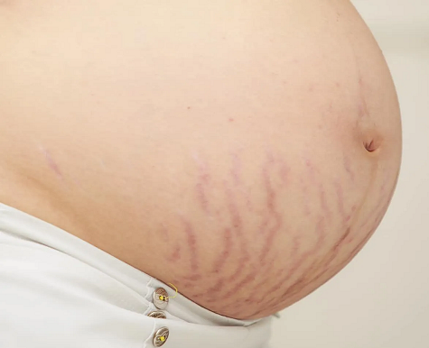 REMOVE STRETCH MARKS LIVERPOOL