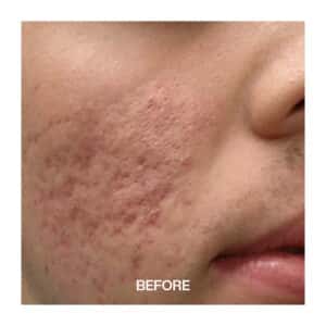 Best Acne Scar Treatments in liverpool