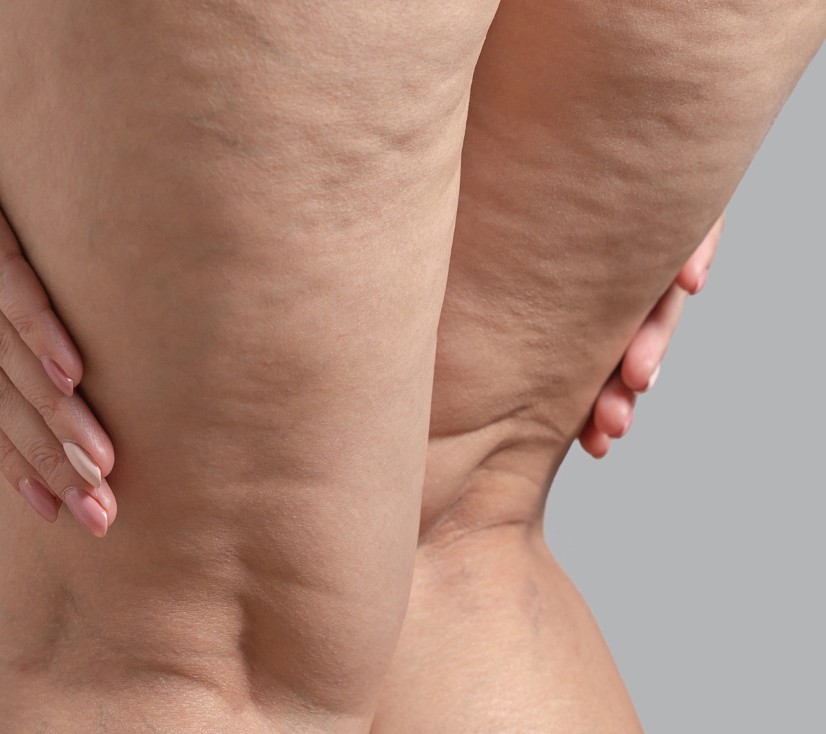 Get Rid of Cellulite  Cellulite treatment Liverpool