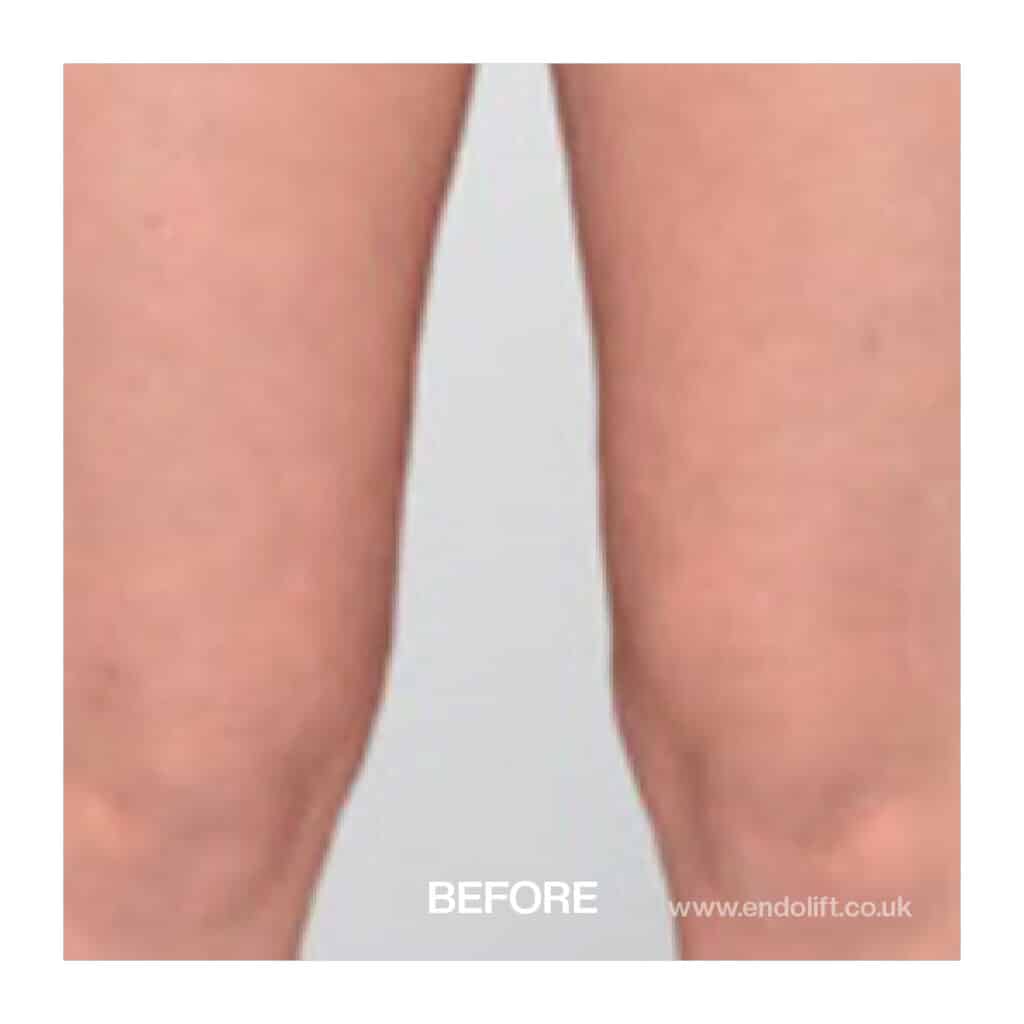 Inner Thigh Lift Liverpool | Skin tightening | Inner thigh