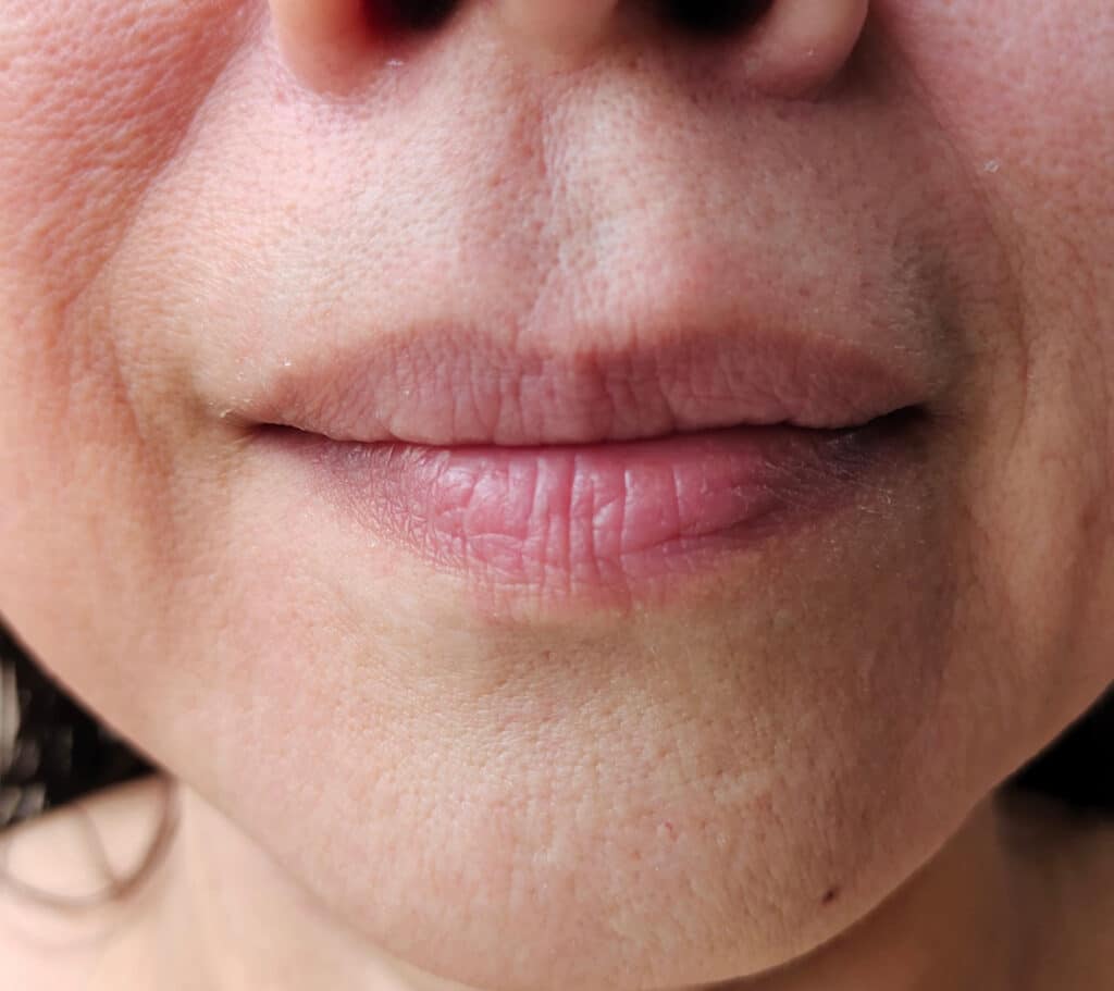 lines treatment Liverpool lines