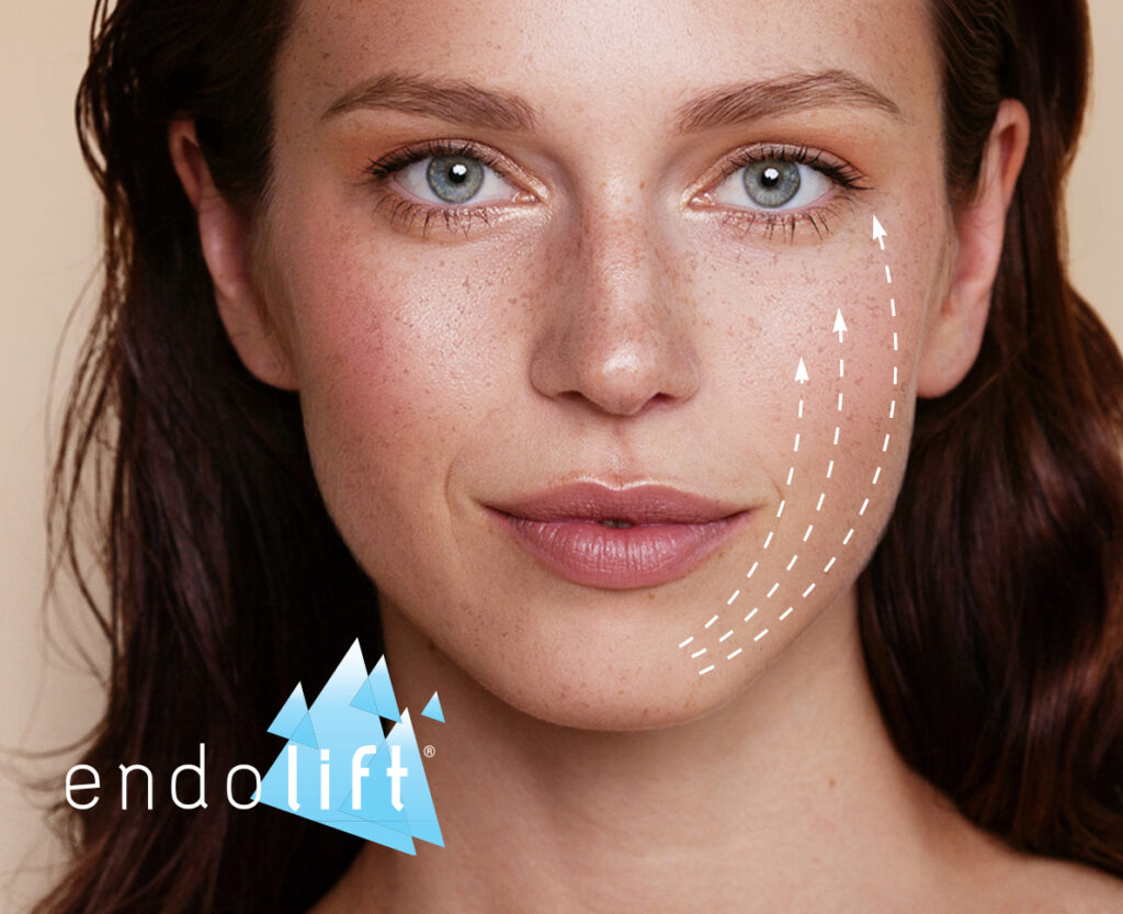 endoliftcost uk