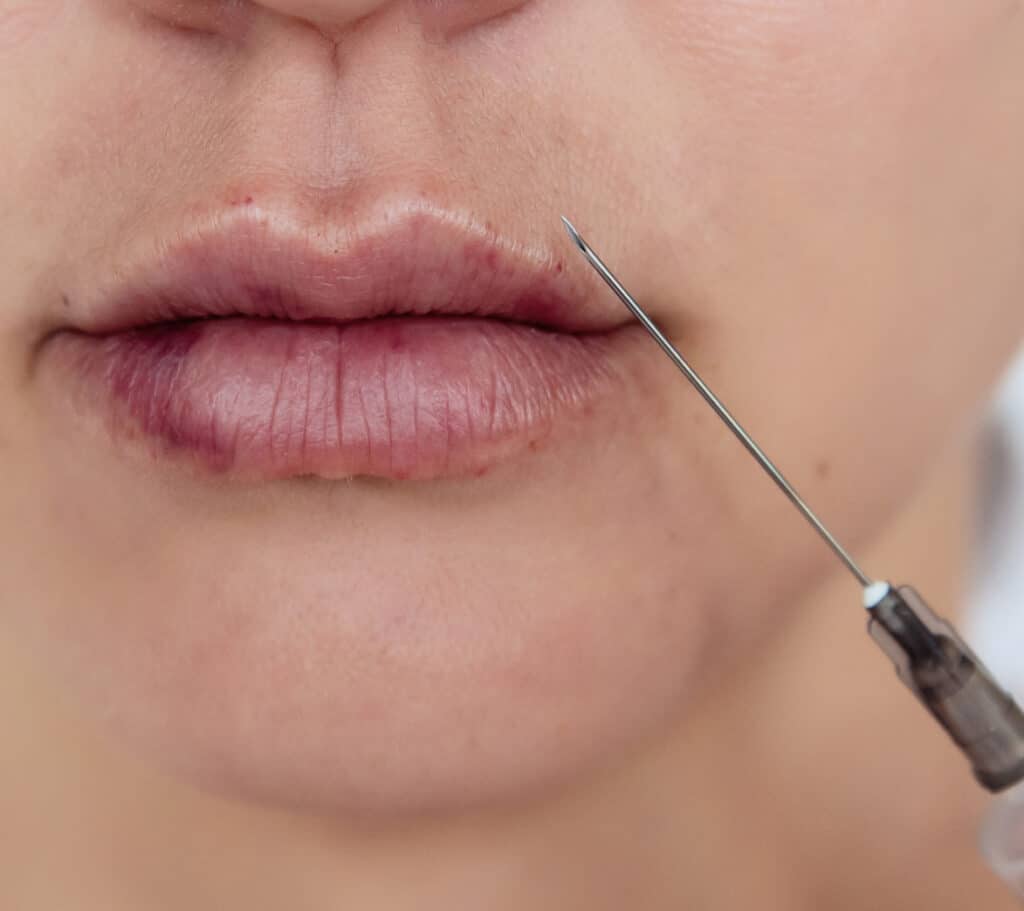 Dermal lip filler Liverpool Swelling after Lip Fillers