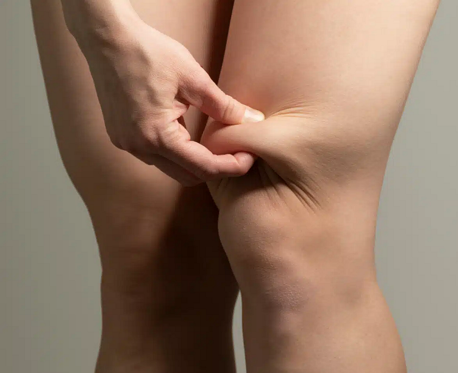 ENDOLIFT SKIN TIGHTENING