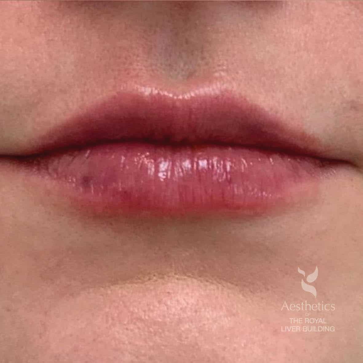lip plumping liverpool image