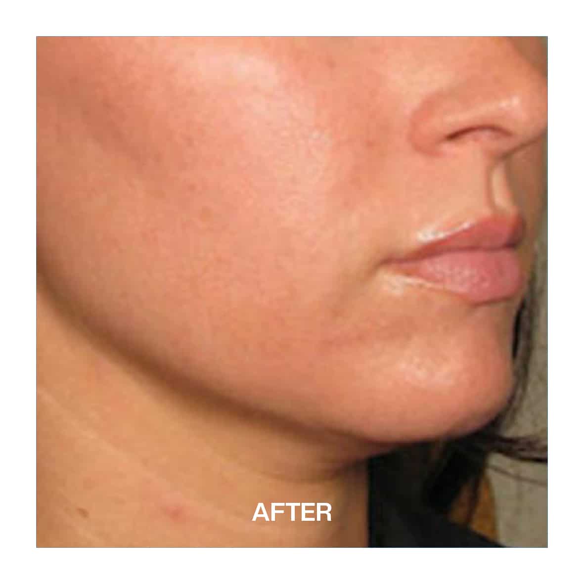 Non-Surgical Facelift Liverpool ULTRA QPRO After