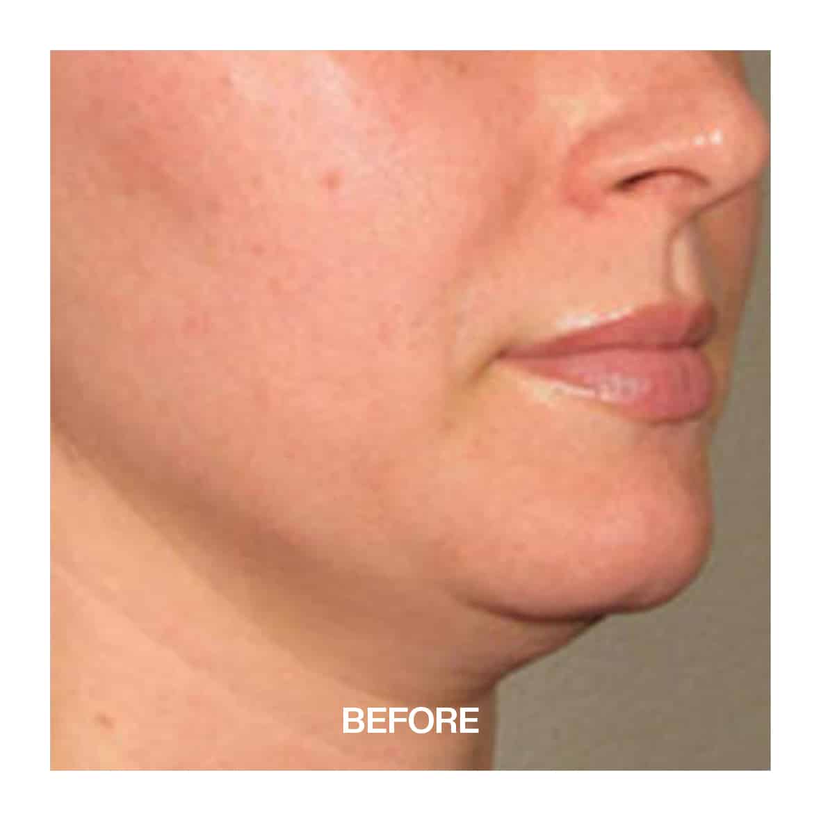 Non-Surgical Facelift Liverpool ULTRA QPRO Before