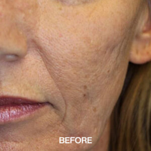 collagen induction therapy liverpool