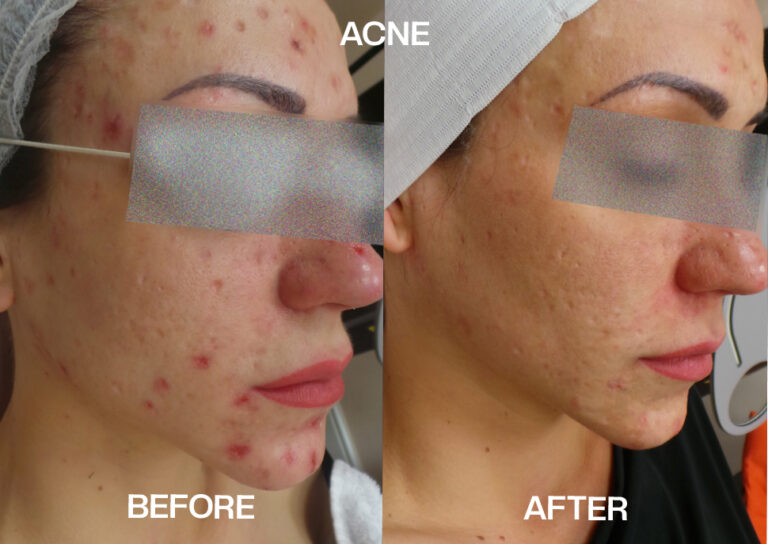 acne scarring treatment liverpool