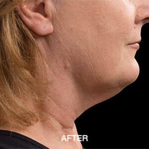 coolsculpting elite double chin after