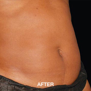 coolsculpting elite tummy after