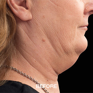 coolsculpting elite double chin before