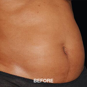 coolsculpting elite tummy before