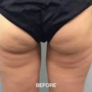 cellulite treatment before