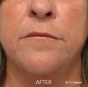 crepey skin after