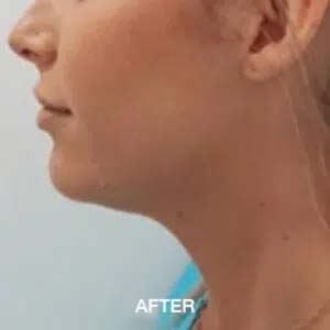 double chin removal after