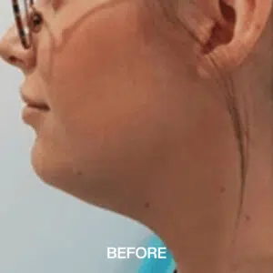 double chin removal before