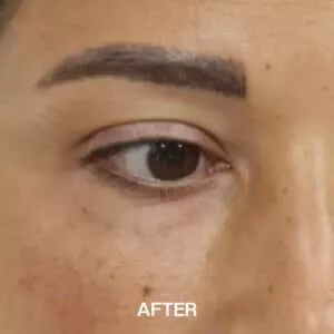 eye bags treatment after