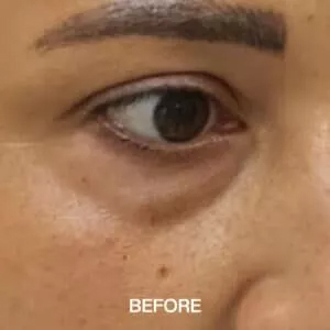 eye bags treatment before