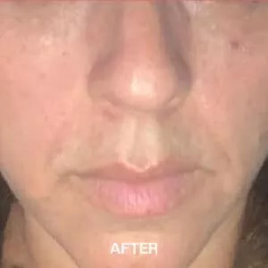 facial volume loss treatments