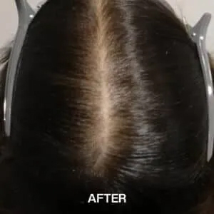 thinning hair treatment