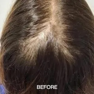 hair loss treatment