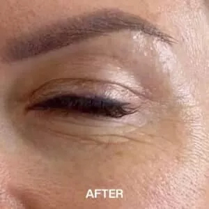 fine lines and wrinkles after image