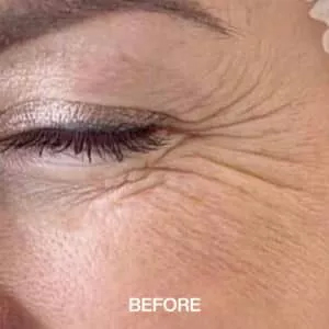 fine lines and wrinkles before treatment