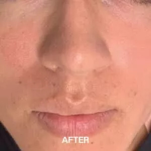 enlarged pores