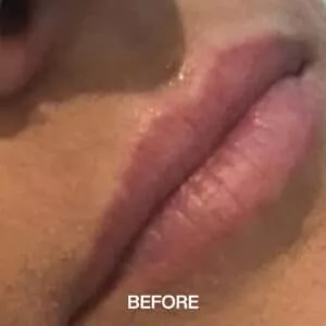 thinning lips before