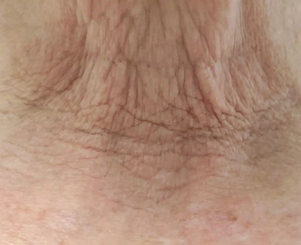 Ageing Neck